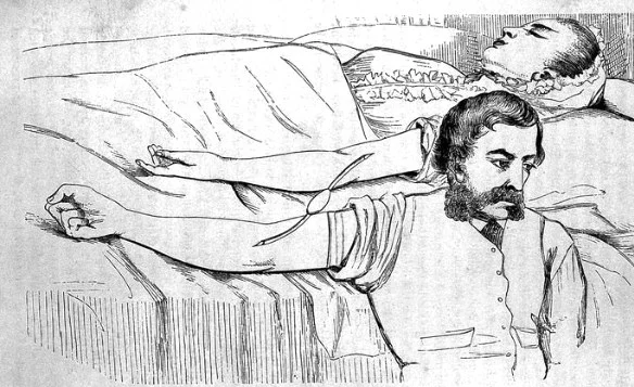 Gravure d’une transfusion sanguine de bras à bras au XIXe siècle